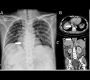 A Retrocardiac Opacity in a Cirrhotic Patient – Esophageal Varices