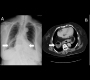 A Retrocardiac Gas-filled Mass – Hiatal Hernia