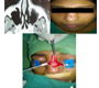 A Case of Midline Nasal Dermoid