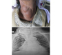 “Ostrich Eggshell” Calcification in Toxic Multinodular Goitre