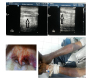 Heparin Induced Thrombocytopenia Due to Low Molecular Weight Heparin