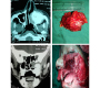 Maxillary Osteosarcoma with Fibrous Dysplasia of Frontal Bone – A Rare Case Blog