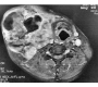 Adenoid Cystic Carcinoma of Submandibular Gland: Case Report
