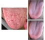 Tongue Abnormalities