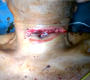 Suicidal Cut Throat Patient – Thyroid Cartilage Totally Injured