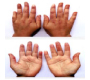 Raynaud’s Phenomenon