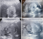 Congenital High Airway Obstruction Syndrome (CHAOS) – A Rare Fetal Malformation Diagnosed on Antenatal Ultrasonography