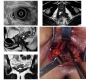 Evaluation of Recurrent and/or Persistent Complex Ano-Perianal Abscess after Surgery: The Unique Value of Magnetic Resonance (MR) Imaging
