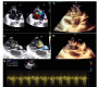 Ebstein’s Anomaly with Gerbode Defect: A Rare Association