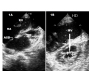 Lutembacher’s Syndrome with Right Heart Failure-echocardiographic Findings
