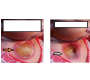 Sternal Cleft – A Rare Entity