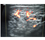 Sonographic Picture of Sjögren’s Syndrome