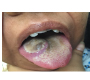 Chloroma of the Tongue in a Patient with Acute Myeloid Leukemia