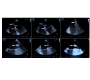 Unusual Association of Cardiac Anatomic Variants and Pitfalls with a Simultaneous Presence of a Coumadin Ridge and a Lipomatous Hypertrophy of the Interatrial Septum