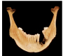 Bilateral Bifid Mandibular Condyles with Three Dimensional Reconstruction of CBCT Scan