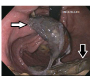 Intragastric Erosion of an Adjustable Gastric Band