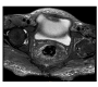 Rectal Dieulafoy’s Lesion Detected Using MRI of Pelvis – First of it’s Kind