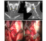 Temporomandibular Joint Pain Radiating to Neck Leading to Eagle’s Syndrome