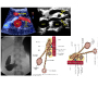 Nutcracker/SMA syndrome