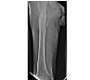 Involucrum –A Rare Pathological Entity of Chronic Osteomyelitis