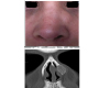 Nasal Intraosseous Hemangioma: A “Honeycomb” Lesion
