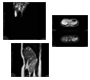 Caroli Disease