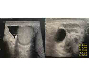 Scrotal Calculi: A Rare Ultrasonography Finding
