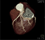 Asymptomatic Marathon Runner with Silent Myocardial Ischemia due Coronary Artery Disease for Proximal LAD Stenosis