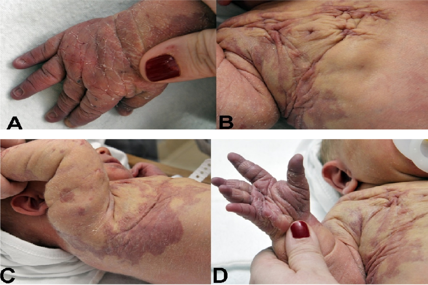 What is the Klippel-Weber-Trenone Syndrome What is the Klippel-Weber-Trenone Syndrome