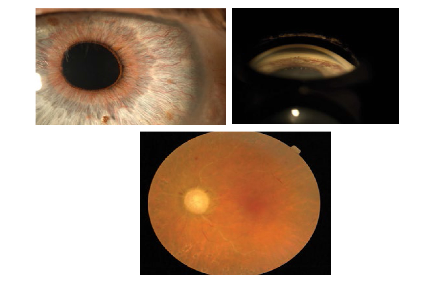 Cornea Verticillata and Obstruccion Carotid