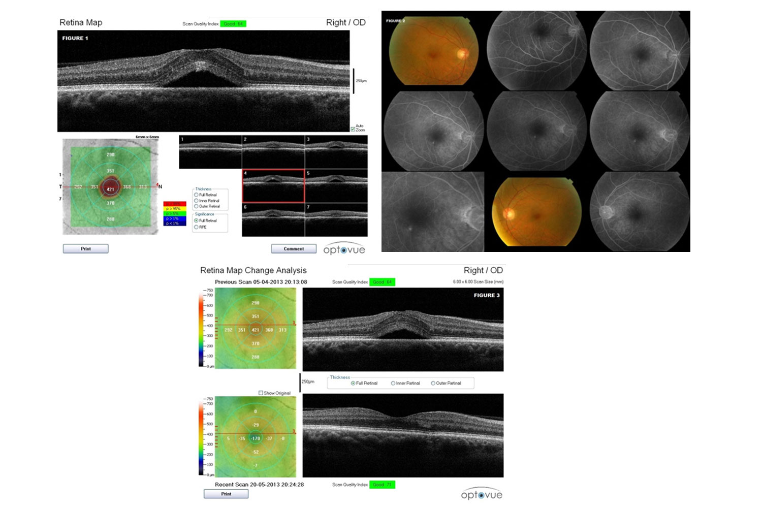 Central Serous Chorioretinopathy