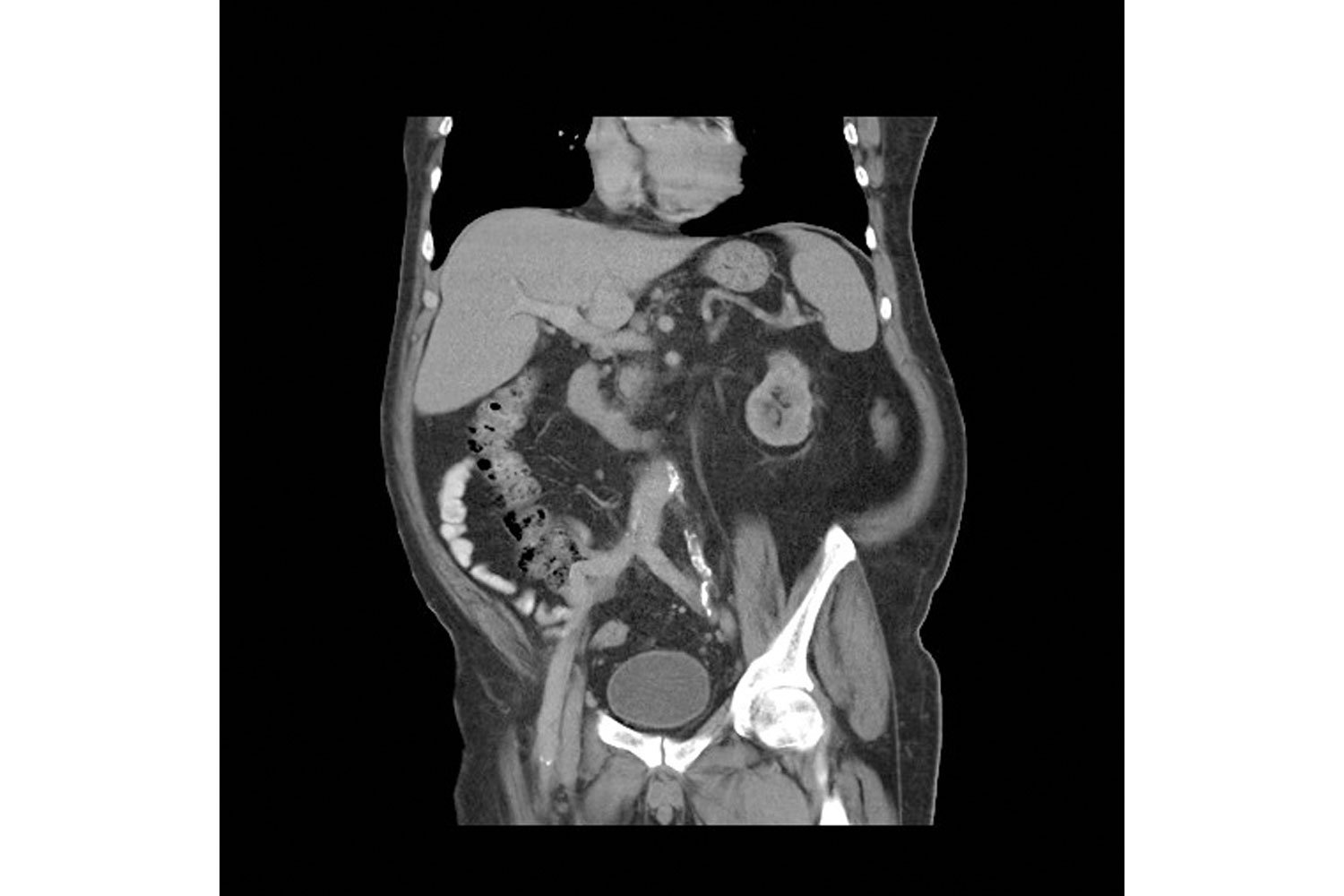 Para-Prosthetic Enteric Fistula Following Aorto-Bifemoral Bypass Surgery