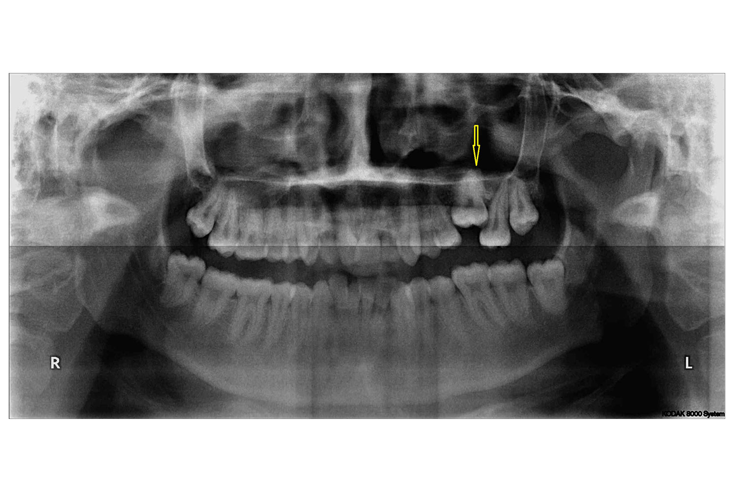 Secondary Retention Of Permanent Left First Maxillary Molar