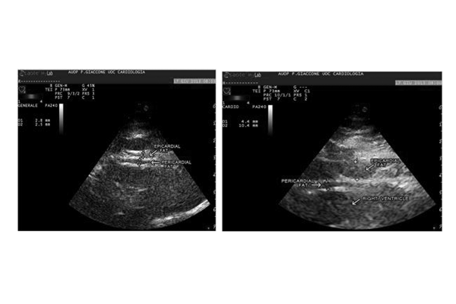 Obesity and cardiovascular risk: The role of epicardial fat measured by echocardiography