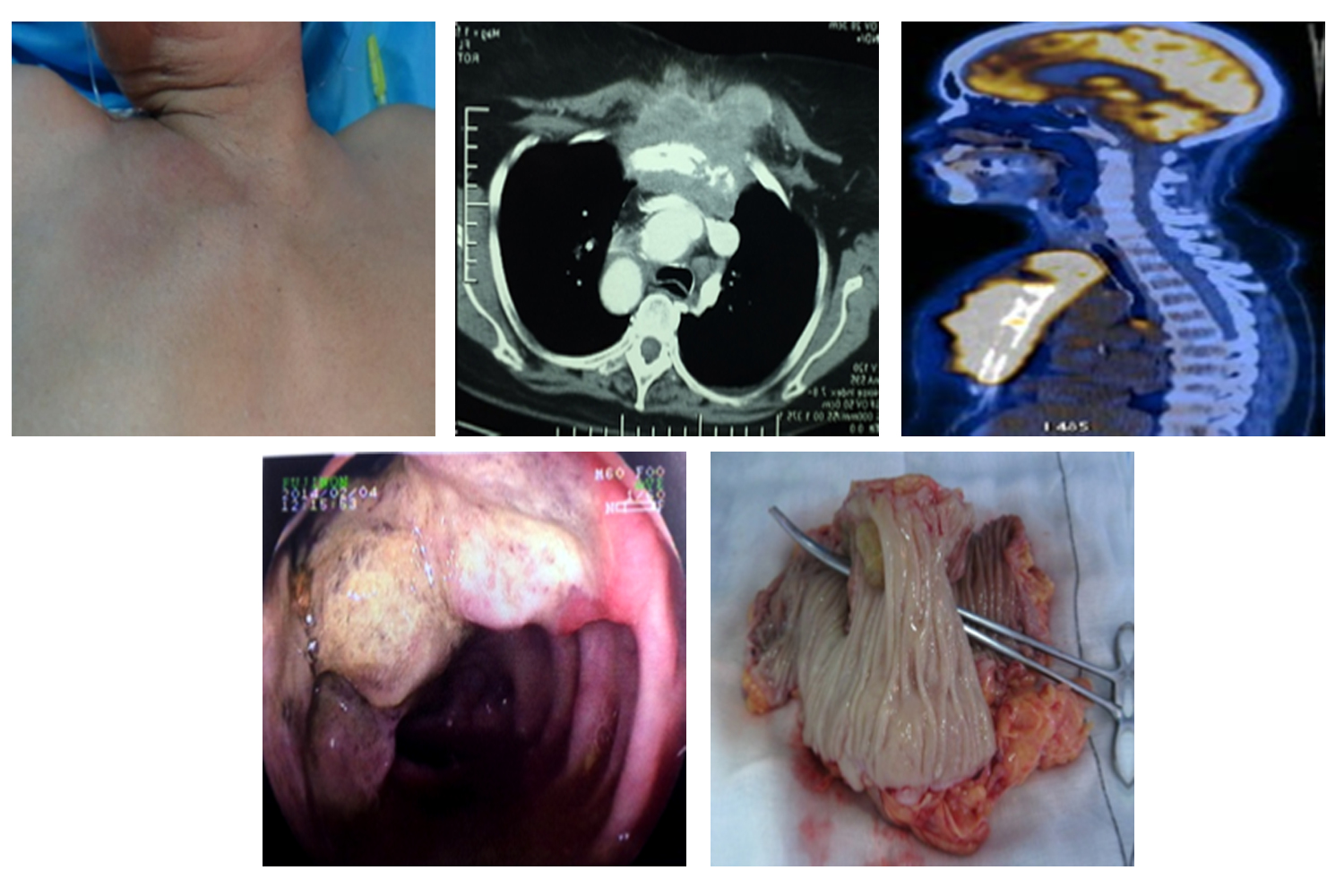 Metachronous Synchronous Sternal and Colonic Metastasis with Asymptomatic Colo-Colic Fistula from Carcinoma Ovary