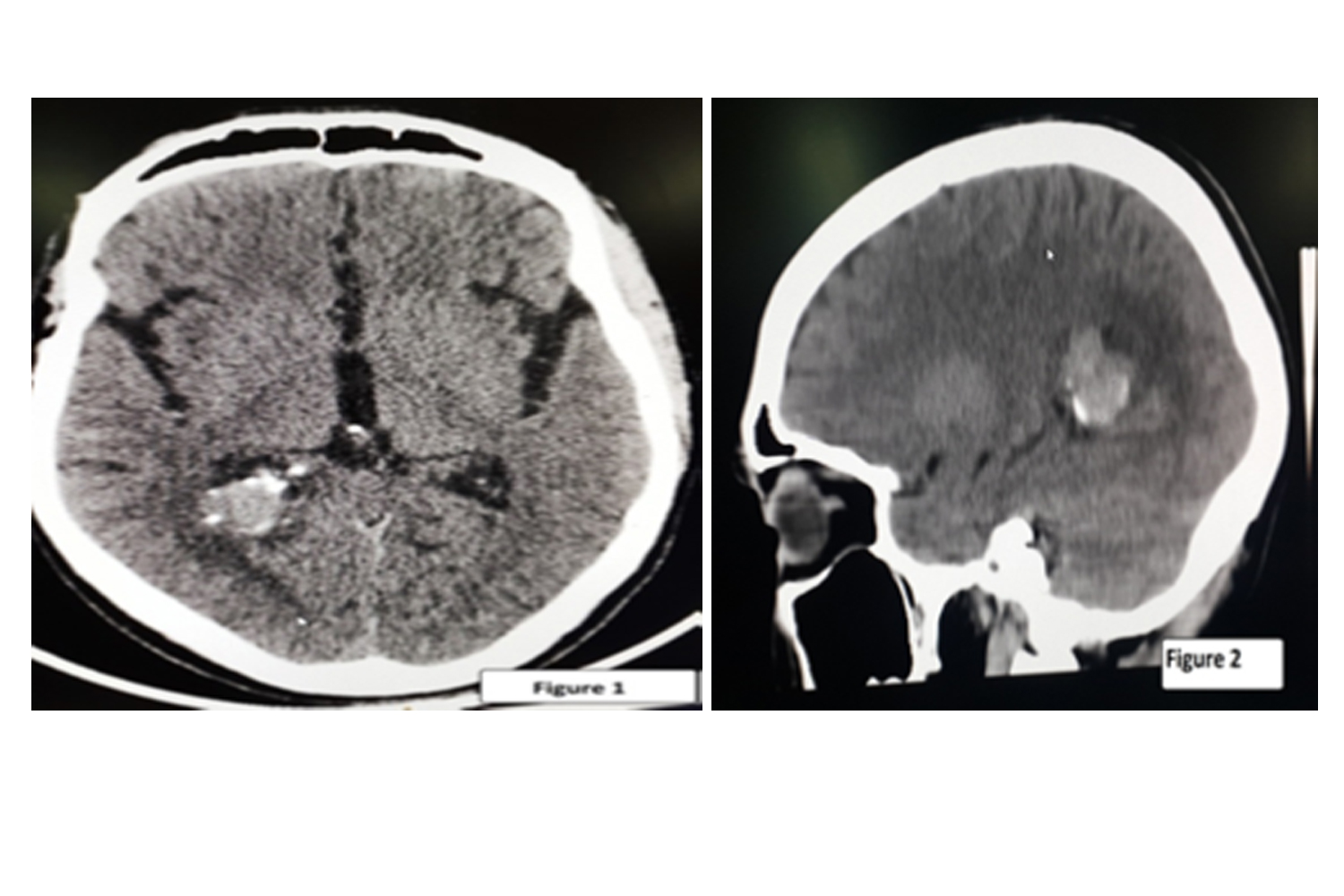 Choroidal Plexus Papiloma (CPP)