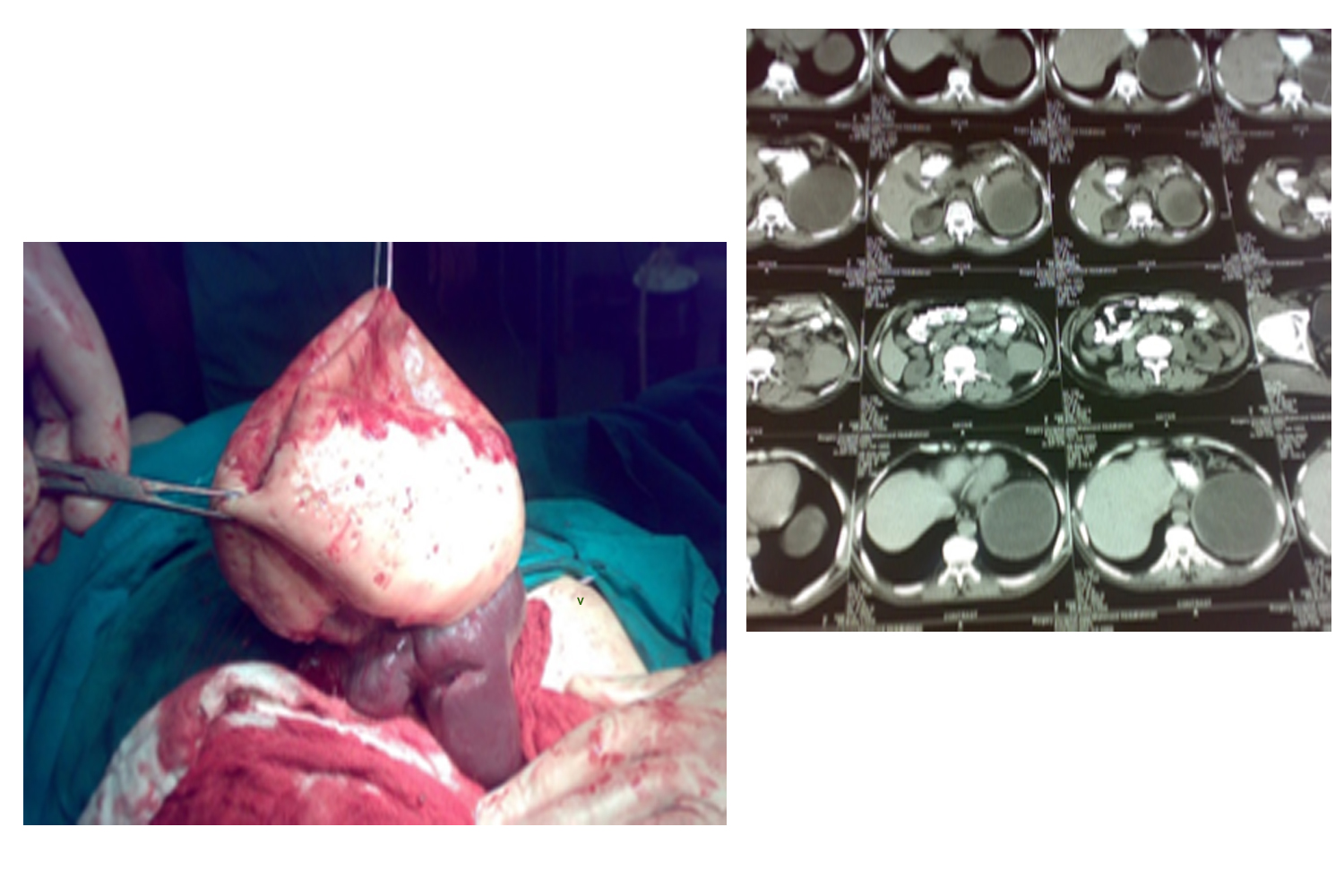 Primary Splenic Cyst