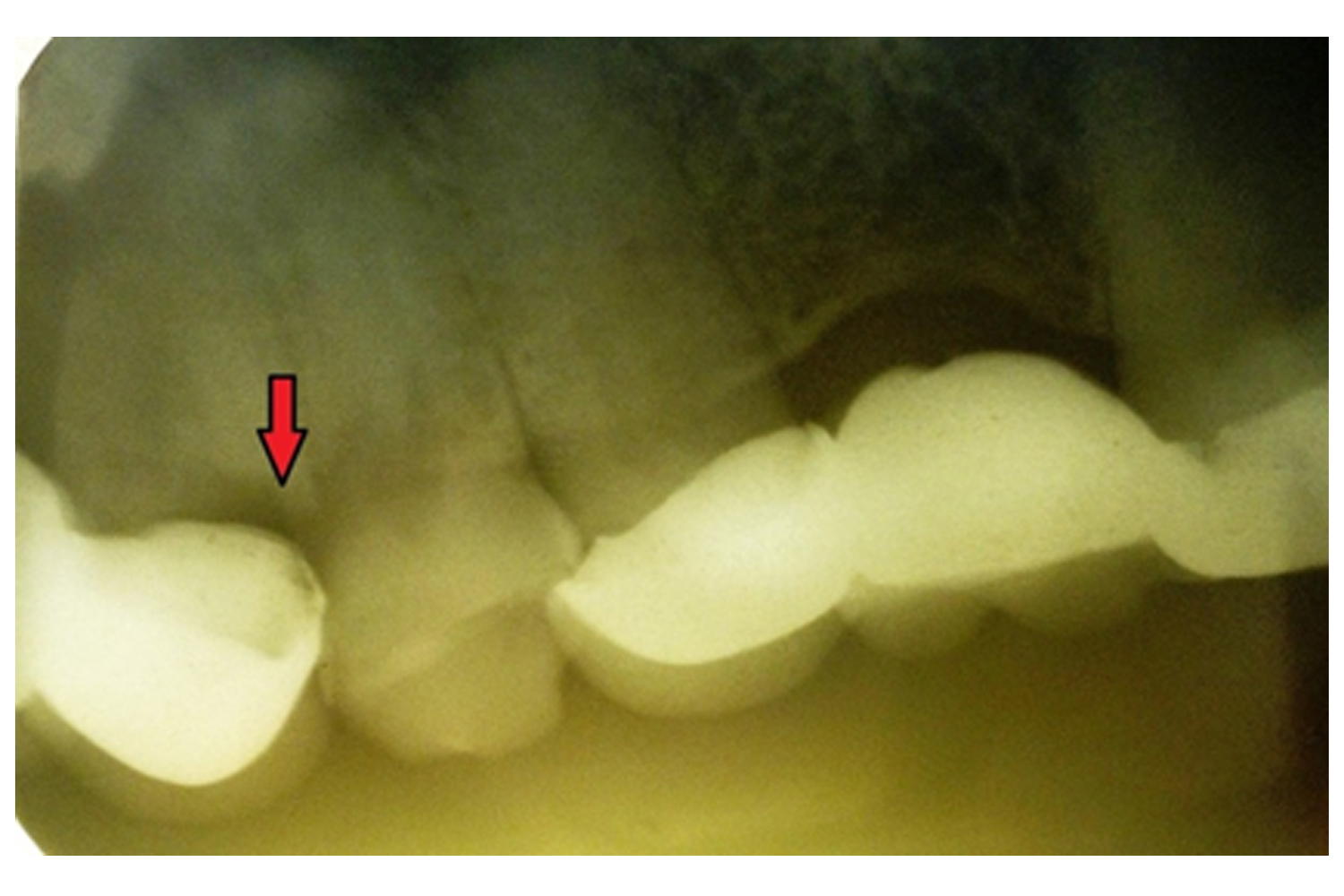 Diagnosing a Case of Cracked-Tooth Syndrome