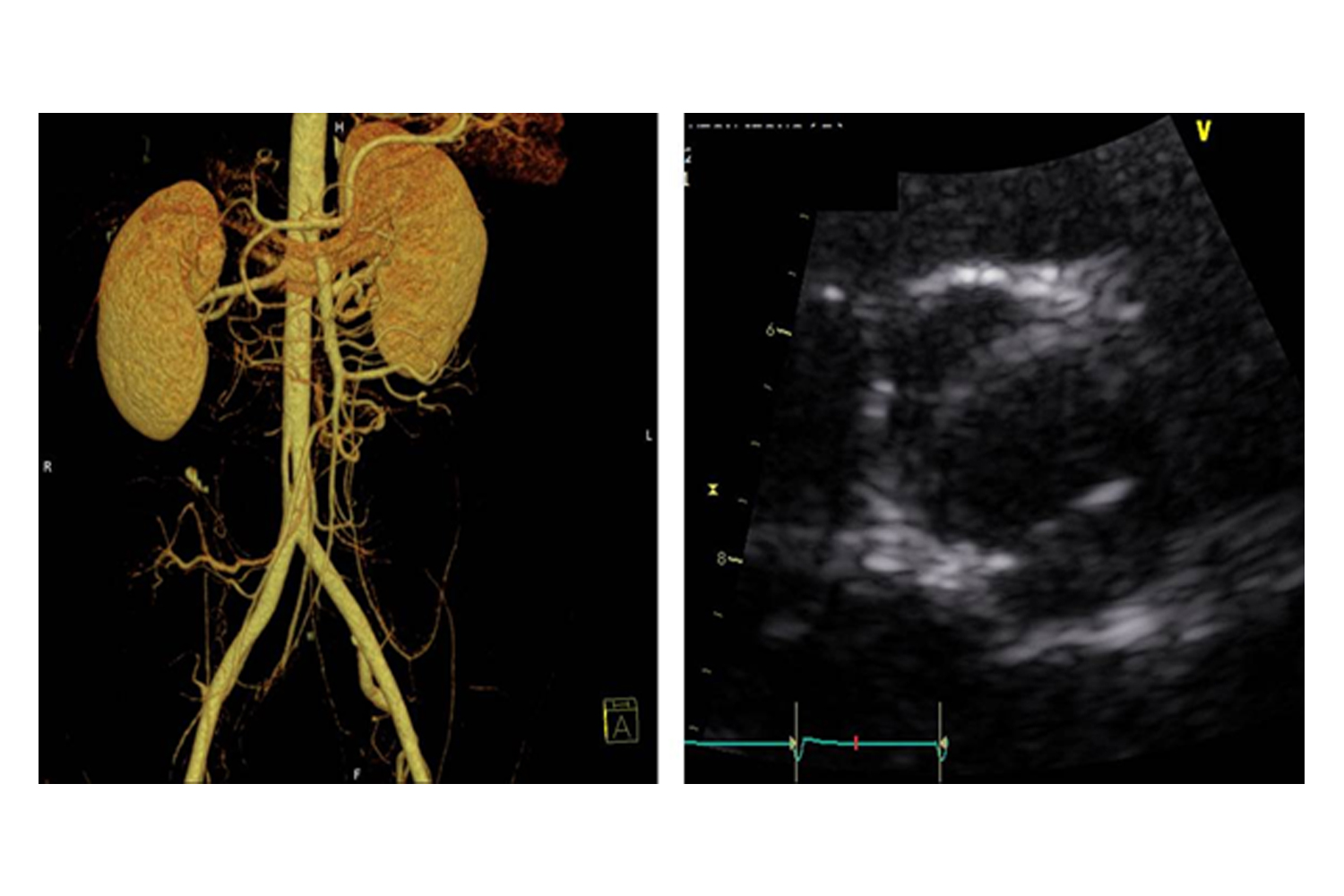 Type B Aortic Dissection and Bicuspid Aortic Valve