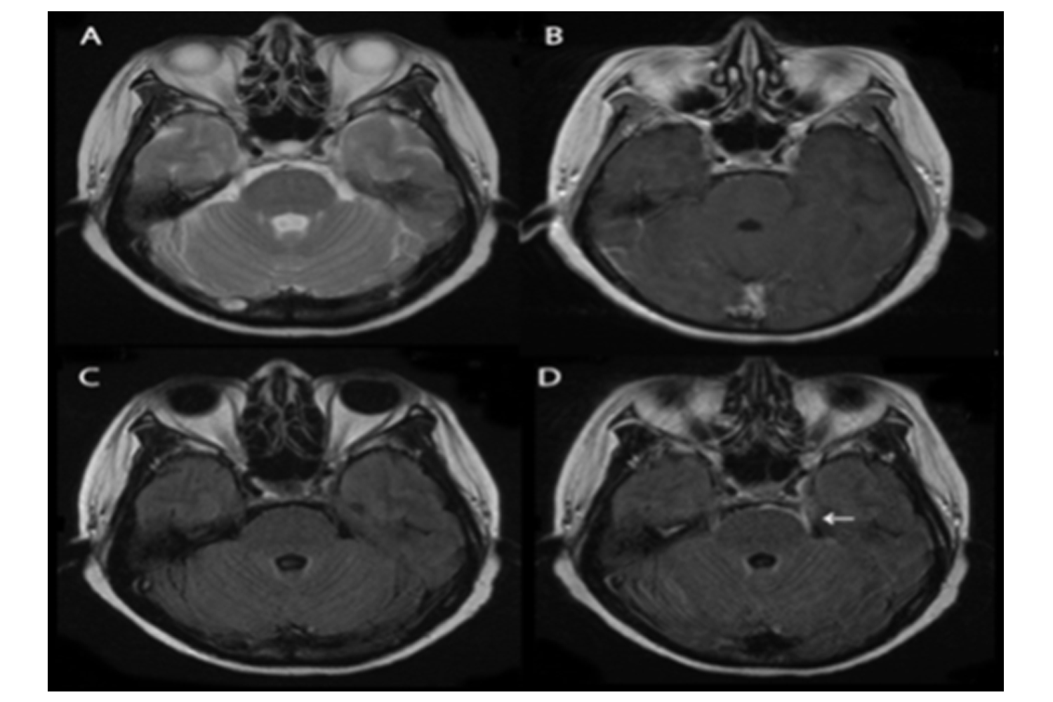 Contrast FLAIR Imaging may be Best Detectable for Leptomeningitis