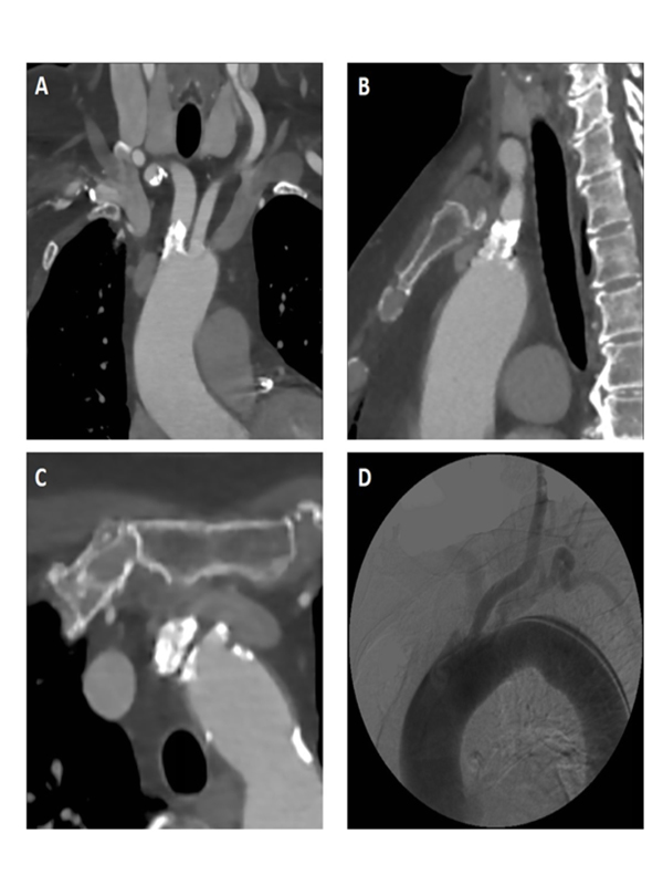 Blood Pressure Difference of more than 100 mmHg between Arms caused by Stenosis of the Brachiocephalic Trunk