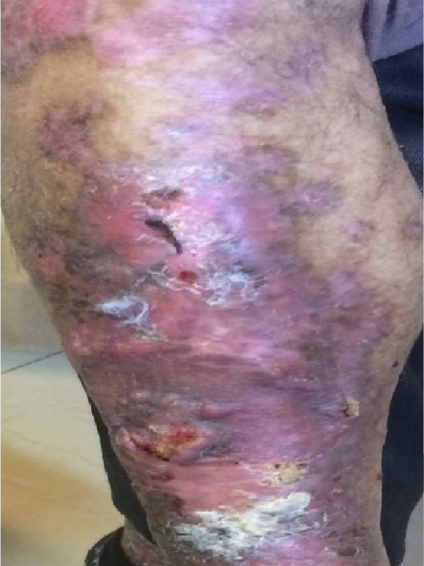A Rare Report of Verrucouse Carcinoma of Right Leg - A Clinical Image