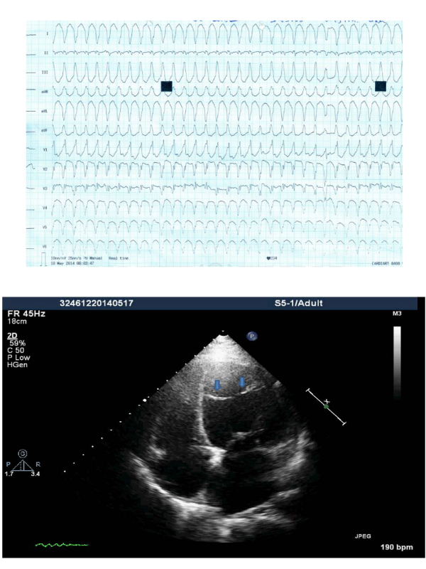 A Case of LV False Tendon with Ventricular Tachycardia