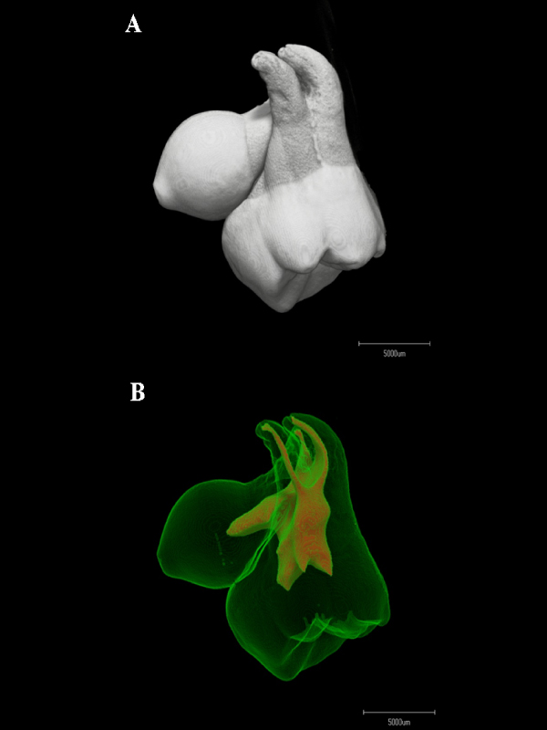 Fused teeth; three-dimensional representation of the external and internal structure