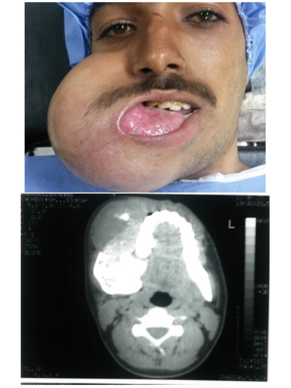 Giant Amelobelastoma with Mandibular Invasion