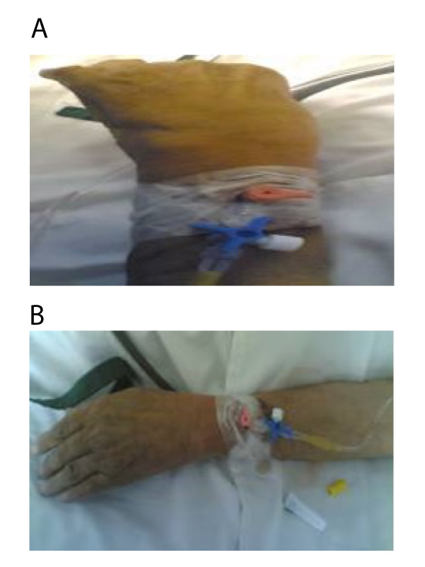 A Rare Technical Error about Angiocath Placement in an Old Patient with Recent Cerebrovascular Accident