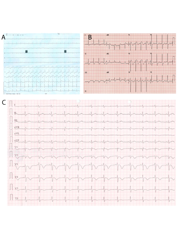 Spontaneous All Three Electrocardiographic Patterns in Same patient with Brugada Syndrome