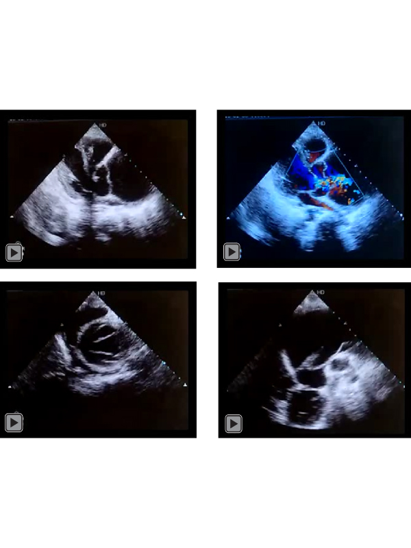 Fatal Type A Aortic Dissection in Young Giving Appearance of Double Aortic Valve with Worms in the Aorta