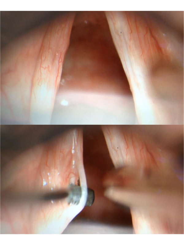 Unusual Case of a Mucosal Bridge of the Vocal Cord