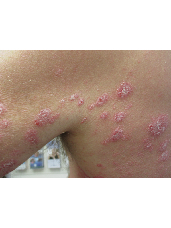 Plaque Psoriasis